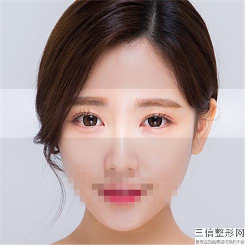 双眼皮术不理想还能修复吗
